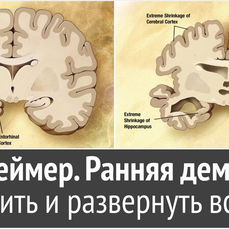Обнаружен метод обращения вспять повреждений мозга при Альцгеймере