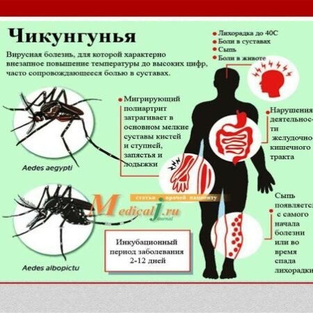 Могут ли россияне заразиться лихорадкой чикунгунья