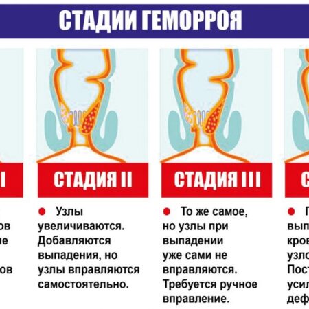 Неожиданная связь между использованием смартфонов и риском развития геморроя