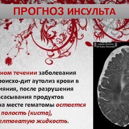 Природное соединение ДМТ: Неожиданный защитник мозга при инсульте