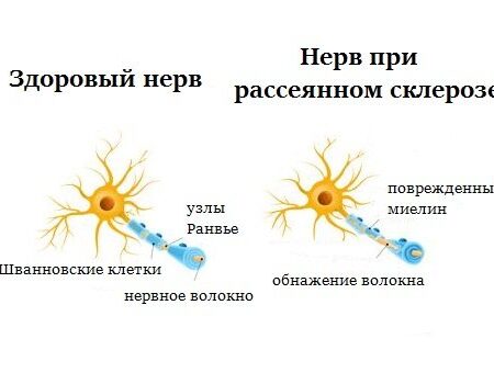 Открыт способ восстановления нервов при рассеянном склерозе