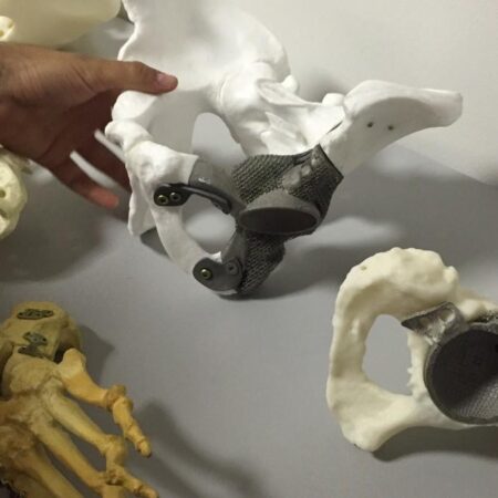 Революция в травматологии: 3D-печать костных имплантов прямо на операционном столе