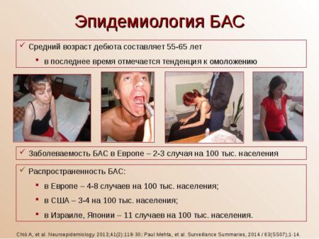 Влияние диоксида серы на развитие бокового амиотрофического склероза: результаты нового исследования