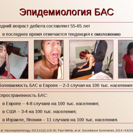 Влияние диоксида серы на развитие бокового амиотрофического склероза: результаты нового исследования