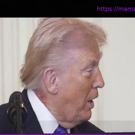 Здоровье Дональда Трампа: что означает сыпь на шее и синяки на руке?